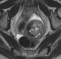 MRI for Cervix and Endometrial