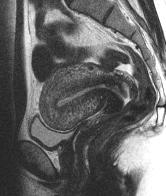MRI and Gynaecological malignancy
