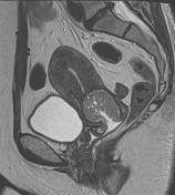 MRI and Carcinoma of the Cervix Increased fibrous tissue in the normal cervical stroma Lower