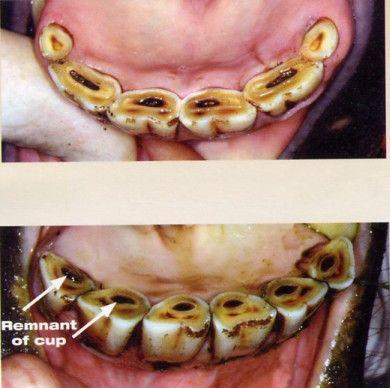 incisor biangular Guidlines Infundibular cup