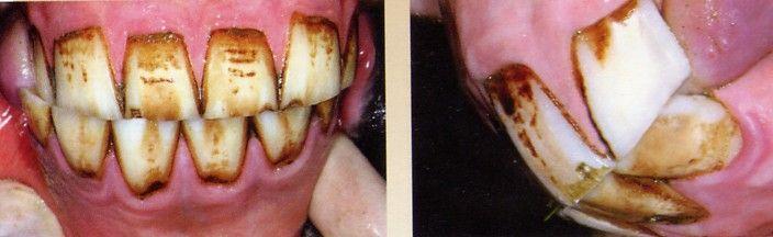 Eight  incisor