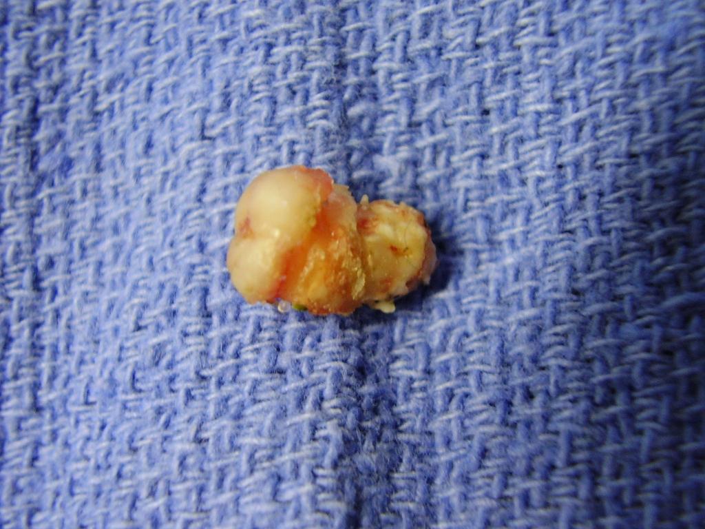 tooth Un-erupted