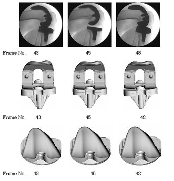 28 M. A. HOSSAIN, M. FUKUNAGA and S. HIROKAWA the tibial rotations and translations relative to the femur without insert and with insert. Because of space limits, only 5 images are shown.