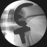 A Kinematic Assessment of Knee Prosthesis from Fluoroscopy Images 29 rotation especially z-rotation of the femur changes much between any two frames but that of the tibial component changes little.