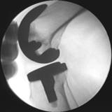 Since the patient was supported on both sides, she did not put her total body weight on her prosthetic knee. Still it was possible to introduce the contact points. From Fig.