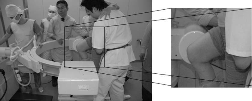 24 M. A. HOSSAIN, M. FUKUNAGA and S. HIROKAWA For the overlapping method, Fig. 6(a) and (b) show the simulation results for the femoral and tibial components respectively.