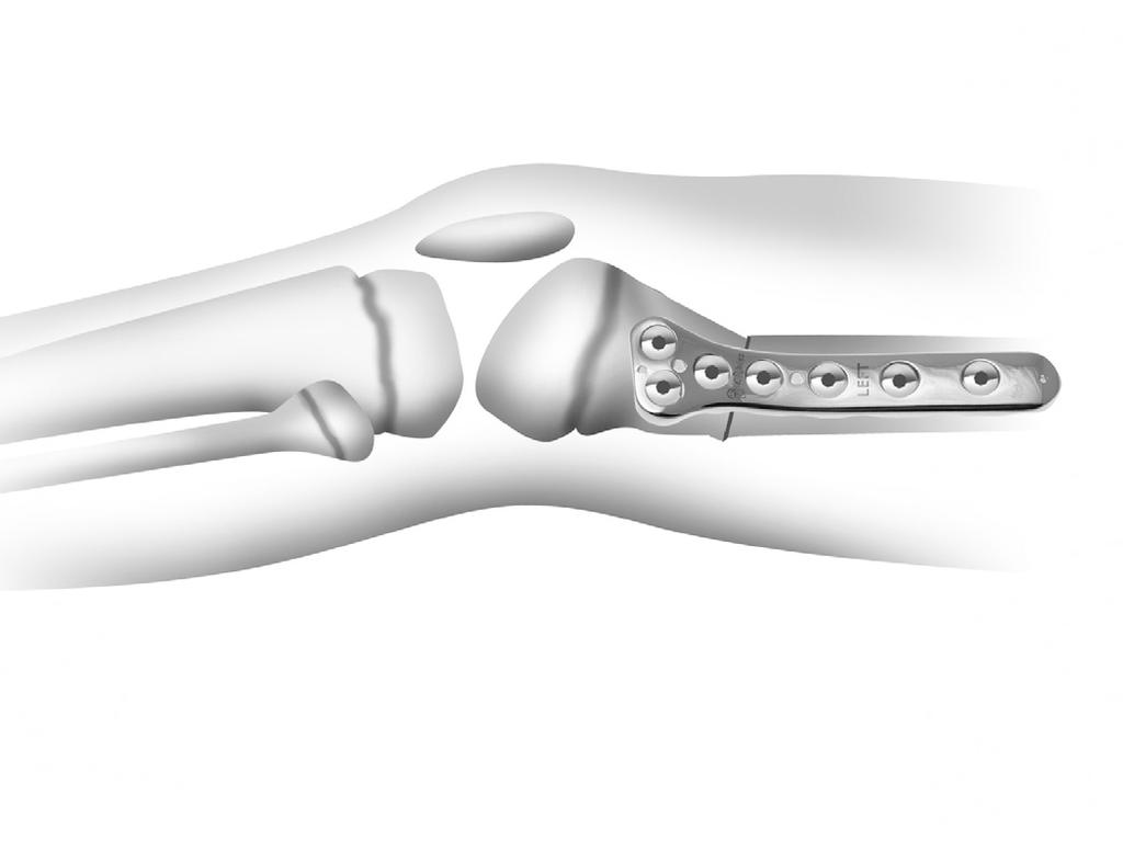 Residual static knee flexion contracture is treated by a compensatory osteotomy of the distal femur of the exact same degree as the knee flexion contracture.