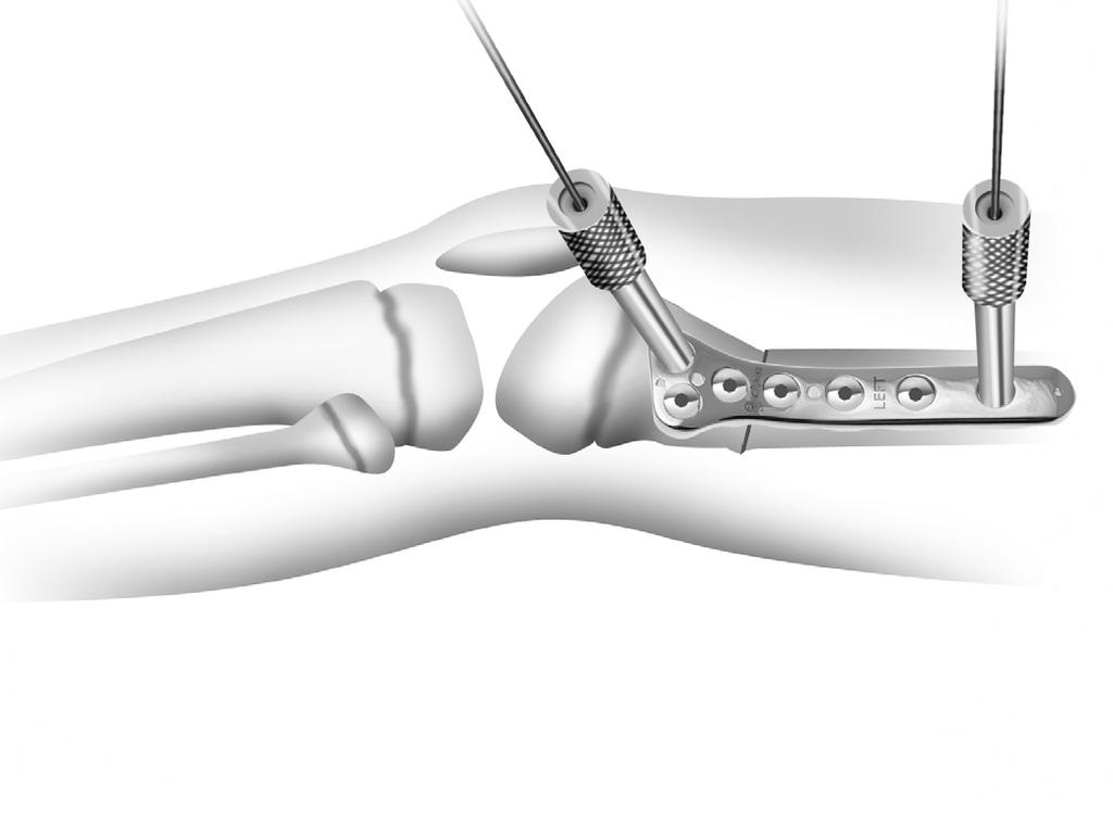 Perform Osteotomy Using an oscillating saw, cut the femur perpendicular to the long axis of the femur. Make a second cut to match the angle of correction desired and remove the wedge of bone.