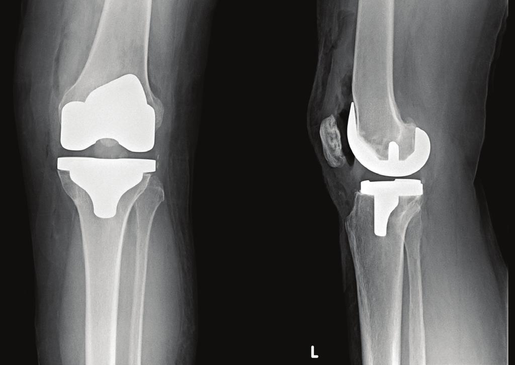 CASE 1 PATIENT 57 year old female, 18 months after a primary total knee arthroplasty. CLINICAL PRESENTATION Persistent pain, swelling and instability.