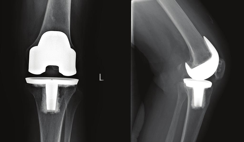 CASE 2 PATIENT 77-year-old female with recent MCL injury on 10-year-old left TKA.