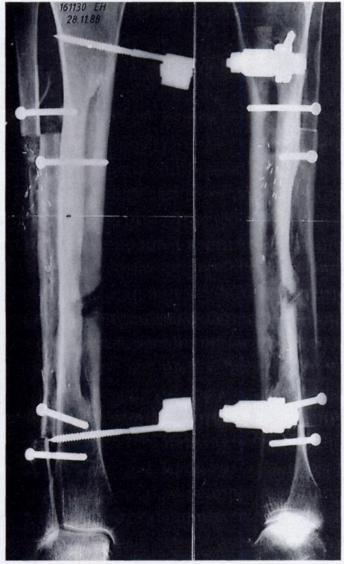 USE OF THE IPSILATERAL VASCULARISED FIBULA FOR TIBIAL