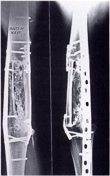 nonunion of the tibia (c) and inversion of a double strut