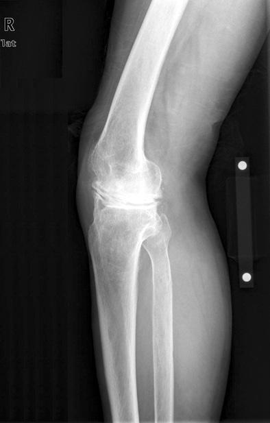 A 66-year-old male visited our clinic with right knee pain and limitation of range of motion (ROM) that