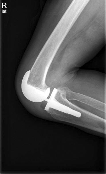 (A D) Anteroposterior and lateral roentgenogrms were obtained at 3-year follow-up examination after total knee arthroplasty using a posterior stabilized prosthesis: the implant was well fixed and in