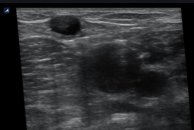 DU during endovenous procedures Reverse Trendelenburg position Imaging scanning the whole veins,