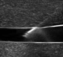 Ultrasound for Saphenous Vein Rx High quality Real-time imaging
