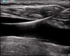 ? Limitations of Ultrasound Anatomical
