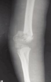 Supracondylar Humeral Fracture in Children Table I Study Fracture Author No.