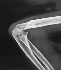 One Ulnar and two interosseus nerve palsies were documented before surgery, and two cases treated with crossed medial and lateral pins had iatrogenic ulnar nerve palsies at postoperative clinical