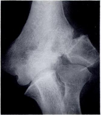 While it is recommended that all displaced fractures should he treated by internal fixatioll those with little displacement are usually treated conservatively.