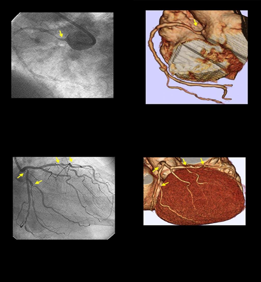 Cath Correlation Cath View Stenosis in proximal RCA