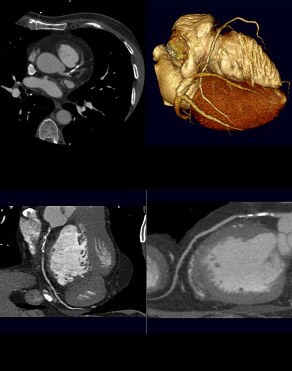 Chest Pain Left main- Distal heterogeneous calcified and noncalcified lesion.