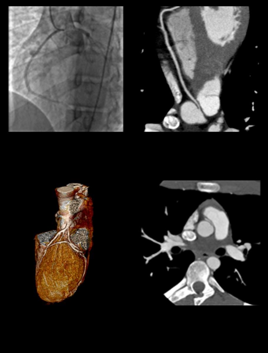 Anomalous RCA 36-year-old female who has chest pain when exercising.