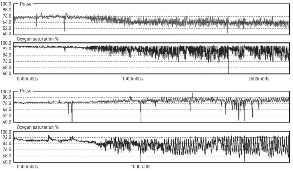 Typical pauern during sleep of a paeent with OSA and overlap syndrome OSA alone Sleep onset Overlap In a patient with both
