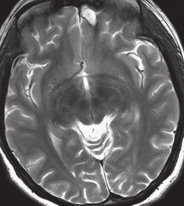 This case report describes a patient with pre-existing JME who developed focal epilepsy which recruited the existing network of generalised epilepsy.