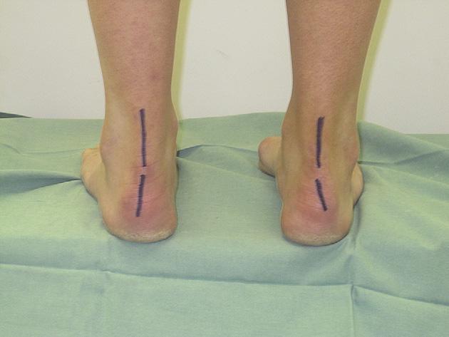 Back: last, turn the patient to inspect the feet from behind. Subtle swelling of the ankle joint can manifest posteriorly by blurring the sharp outline of the Achilles tendon.