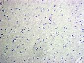 The tumor is composed of cells with strong GFAP expression (d) and rare