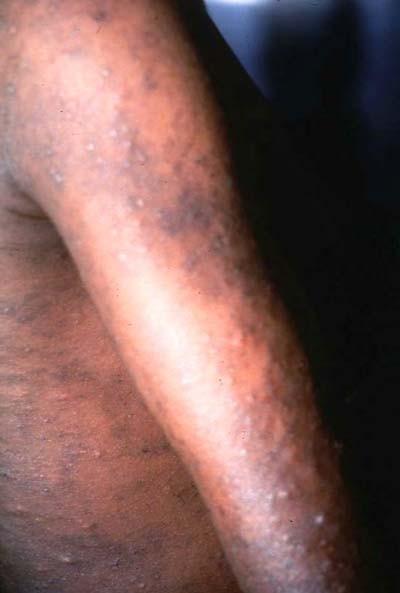 gondii infection Cysticercosis Kala-azar