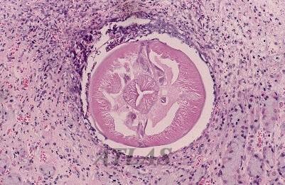 Abdominal pain Entamoeba histolytica (amebic colitis, liver infection) Giardia lamblia Cryptosporidium