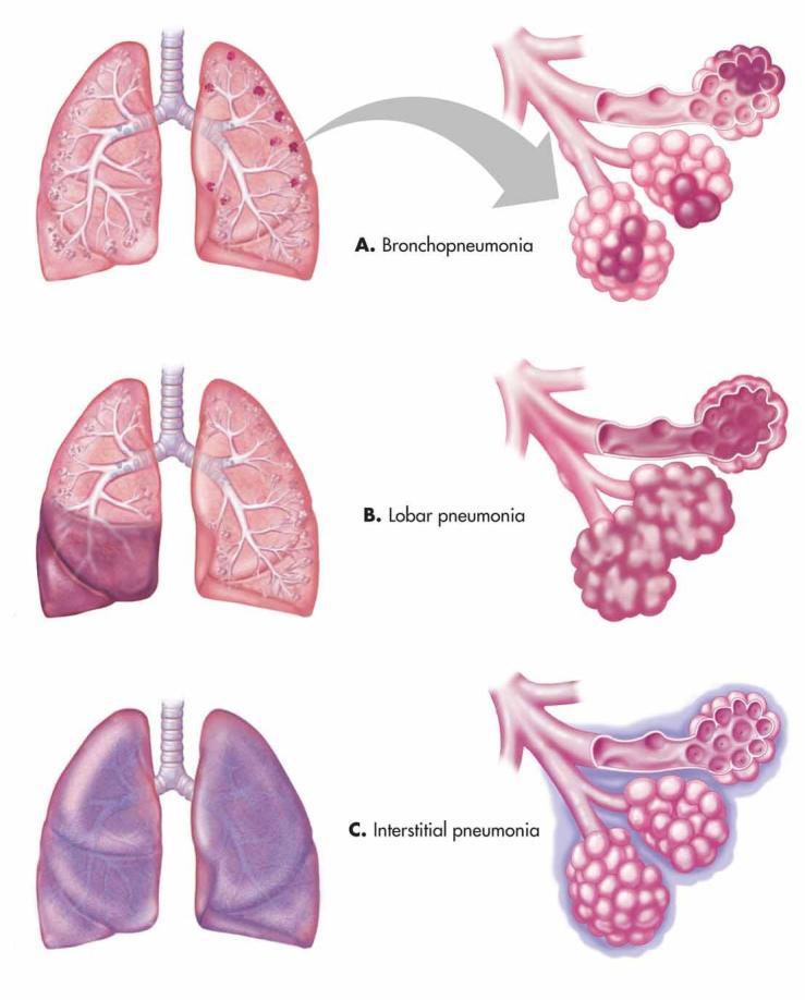 - There are three patterns of pneumonia which are seen on chest x-ray: Lobar pneumonia: caused by bacteria; affecting a