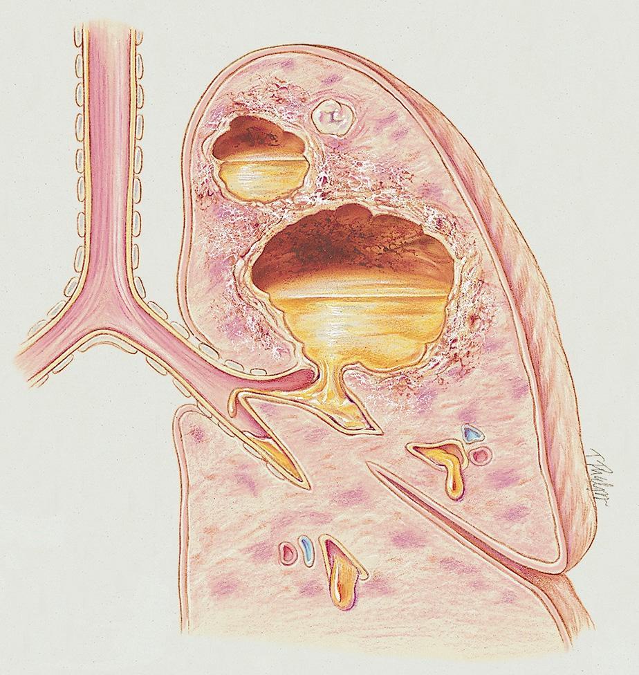 EDA PM C AFC RB A B Figure 16-1. Lung abscess.