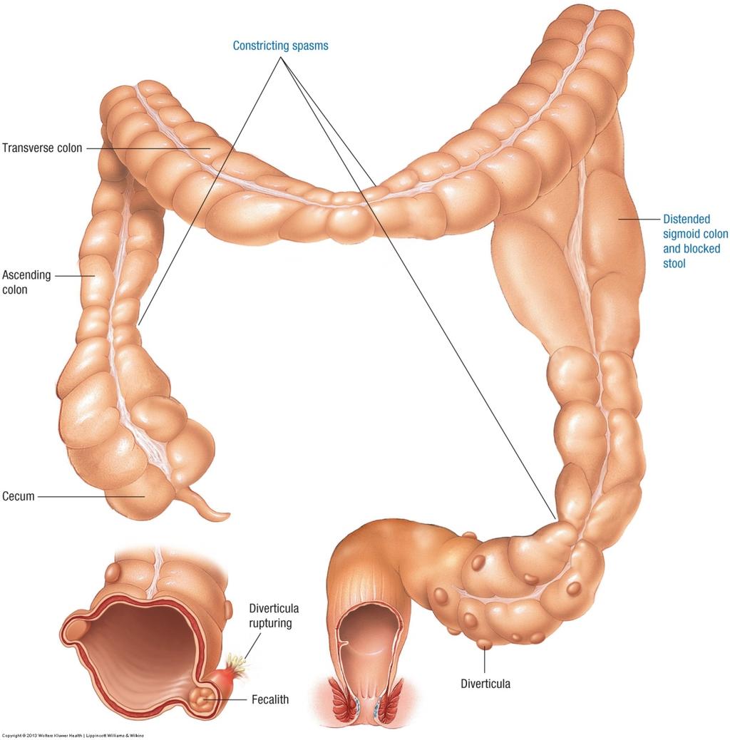 Disorders of the Large Intestines" Diverticular