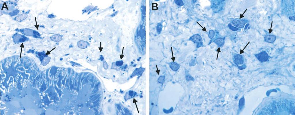 GL-3 is cleared from mesangial cells. (A) Baseline biopsy, pre-treatment. Dense GL-3 granules accumulate around the nuclei of mesangial cells. (B) Post-treatment.