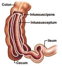 Intestinal Atresia Esophagus Stomach Duodenum Colon