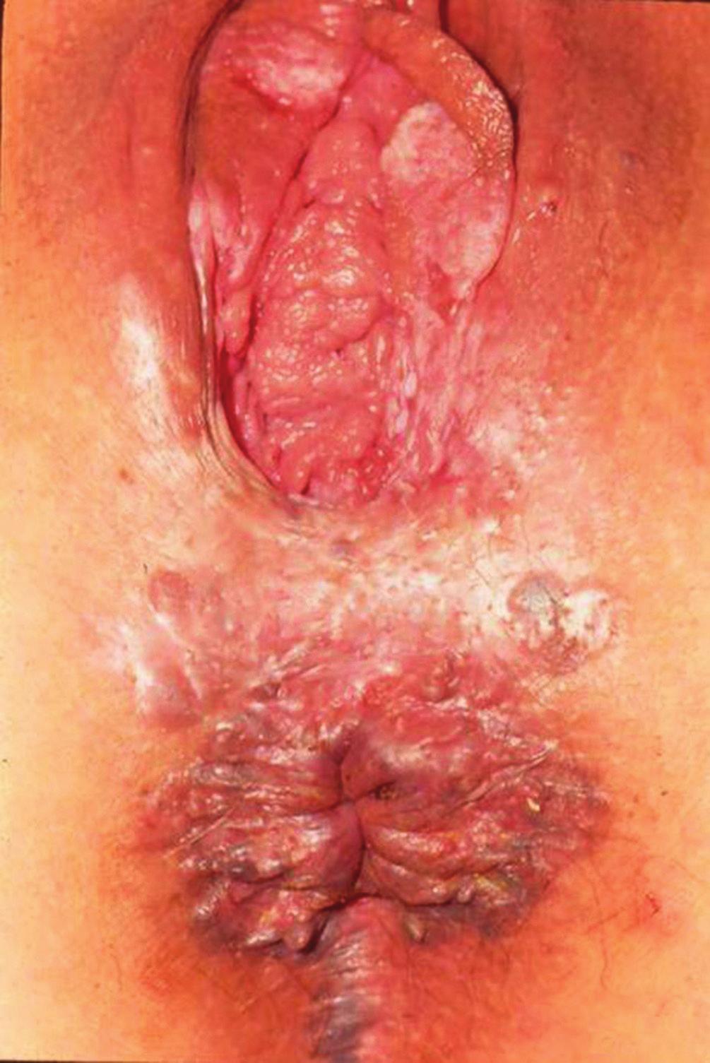 Thereby, hyper-keratotic plaques and pigmented or grayish areas must be biopsied (Figures 3 and 4).