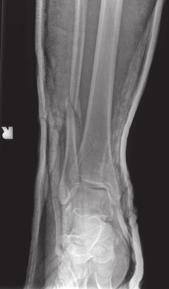Chapter 5. Trimalleolar Ankle Fracture 37 Figure 5.2 Post-reduction radiographs posterior fragments (percutaneous screws) or nonoperative management due to the increased risk for wound complications.