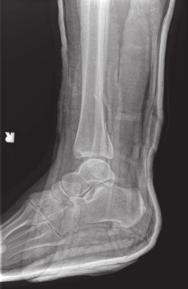 The lateral X-ray is most important in determining the presence and nature of a posterior malleolus fracture.