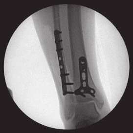 can be approached using a standard medial incision and the fracture repaired in standard fashion.