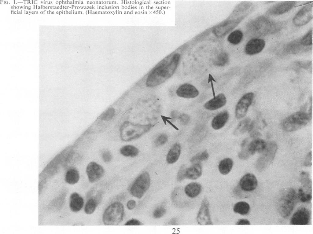 Brit. J. vener. Dis. (1964), 40, 25. GENITAL INFECTION IN ASSOCIATION WITH TRIC VIRUS INFECTION OF THE EYE II. CYTOLOGY.* PRELIMINARY REPORT BY M. KHALAF AL-HUSSAINI AND BARRIE R.