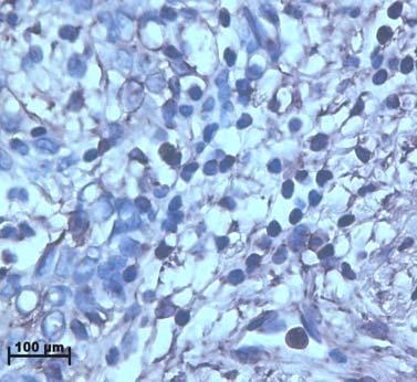 (C) illustrates high expression in moderately differentiated carcinoma and the surrounding stroma and (D) showed high levels