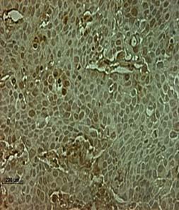 differentiated carcinoma cells.