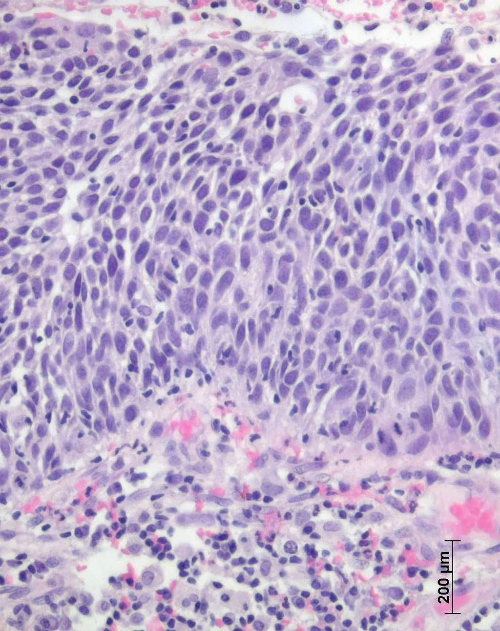 papillary fronds (PF), magnification 400X. N Figure 3.4: H&E of Carcinoma in situ.