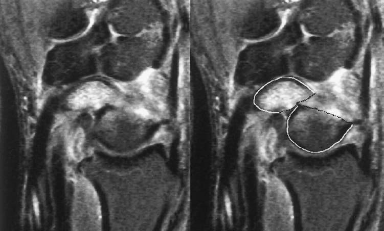 MRI AND PLAIN RADIOGRAPHY IN THE ASSESSMENT OF DISPLACED FRACTURES OF THE WAIST OF THE CARPAL SCAPHOID 709 Fig. 5a Fig.