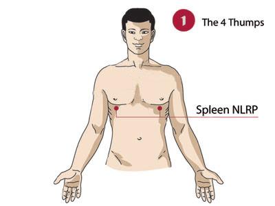 16 STEP 1d -- The Four Thumps Spleen NLRP Thump How To: Tap, or massage the Spleen NeuroLymphatic Reflex Point (NLRP) and/ or the last point on the Spleen Meridian (SP21) for 20 seconds with pressure.