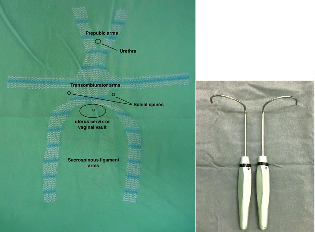 ibju Anterior six arms mesh for high stage vaginal prolapse Figure 2 - Molded anterior apical mesh, transobturator and trans gluteus sacrospinous retrieving needles.