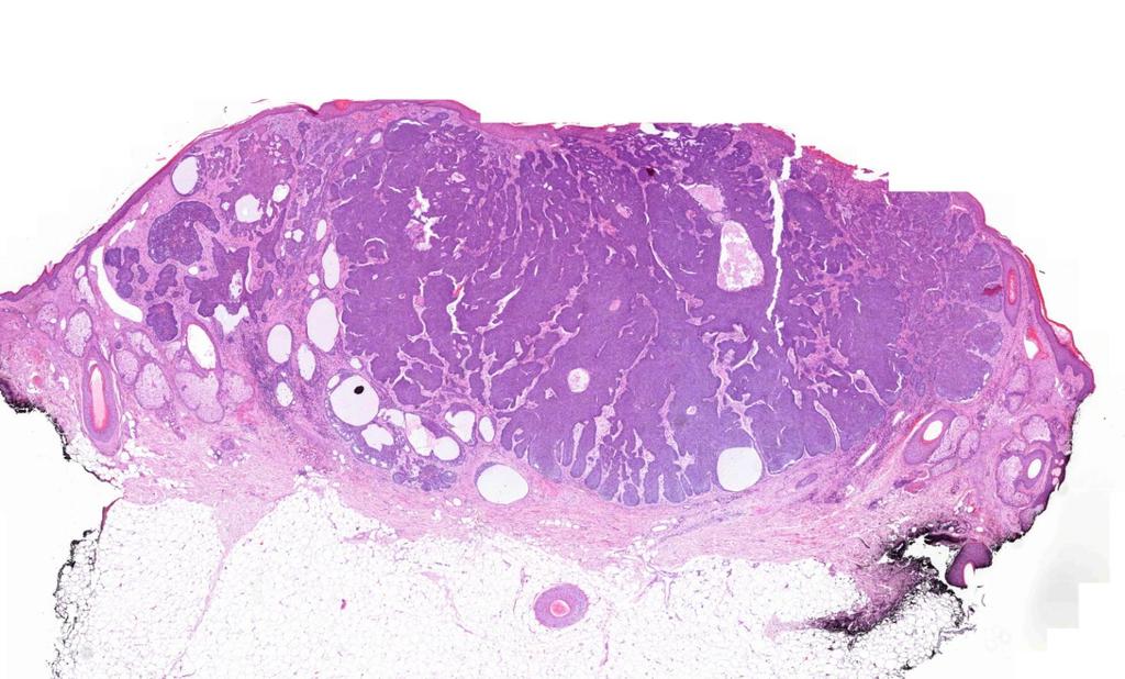 Microscopic features Infiltration of the dermis, the tumor mass
